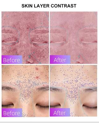 kopen Blue Light Acne Treatment Mask with Intelligent Timer – Manufacturer Direct Supply, Appearance Patent Included online vervaardiging